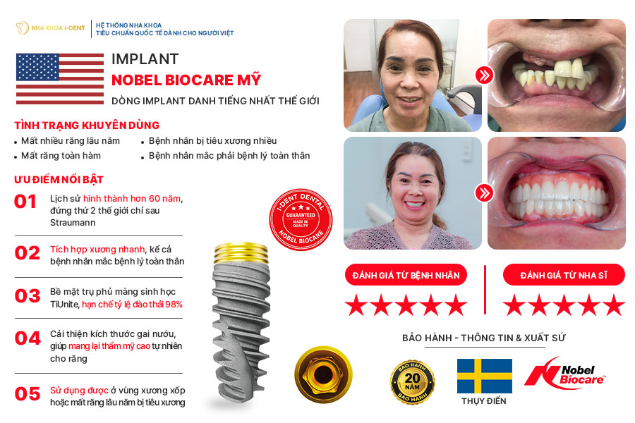 trụ implant mỹ - Nha khoa I-Dent