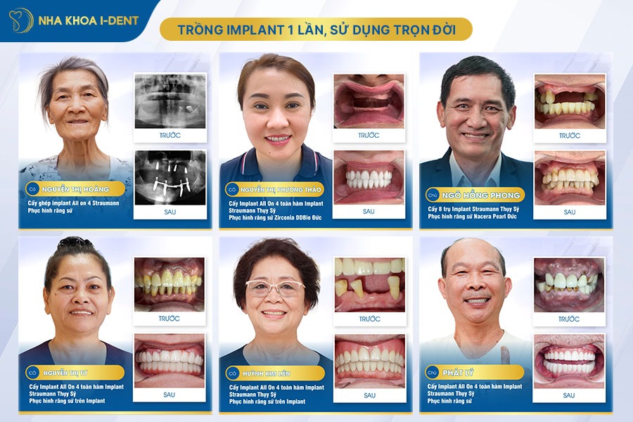 implant straumann thụy sĩ