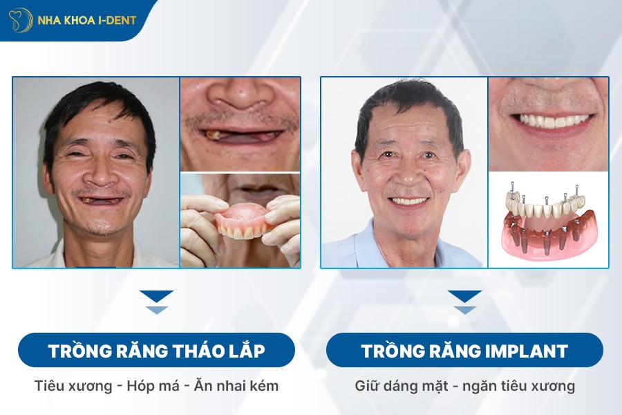 làm hàm răng giả bao nhiêu tiền