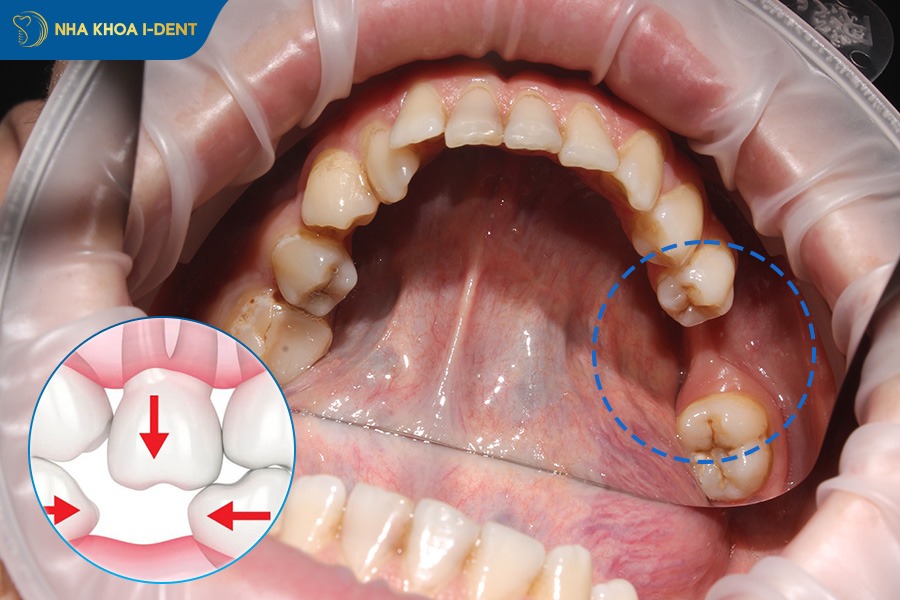 mất 1 răng hàm có sao không