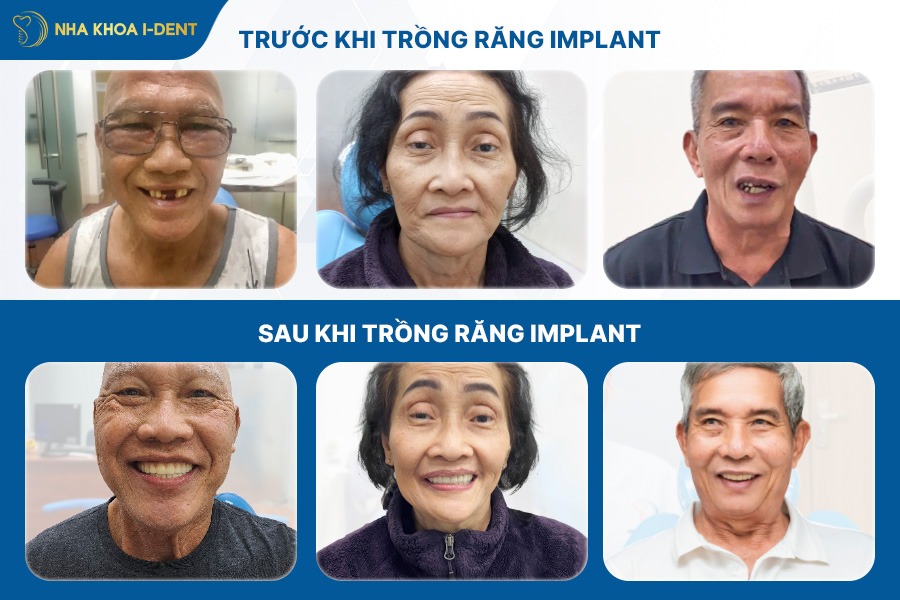 mất răng hàm lâu năm