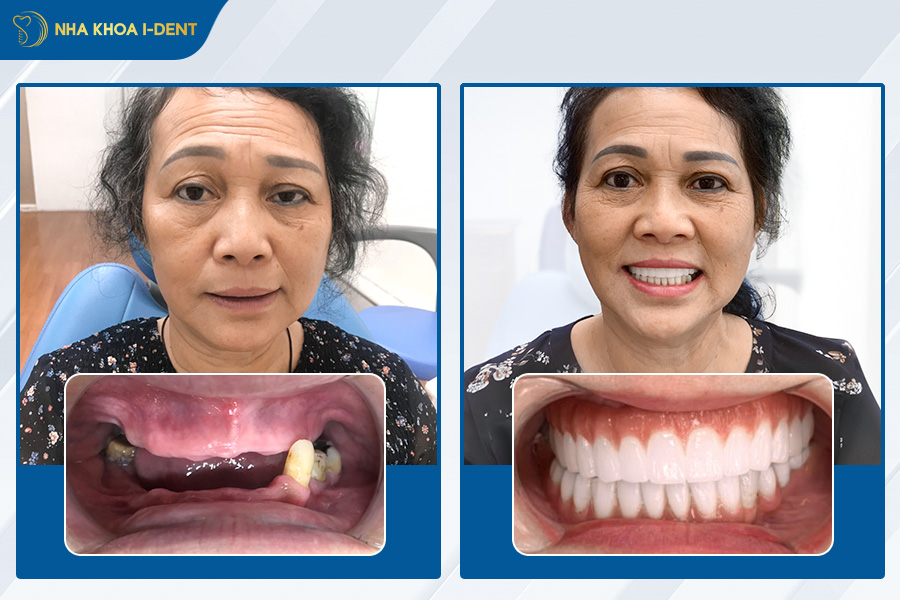 nhổ răng bao lâu thì cấy ghép implant