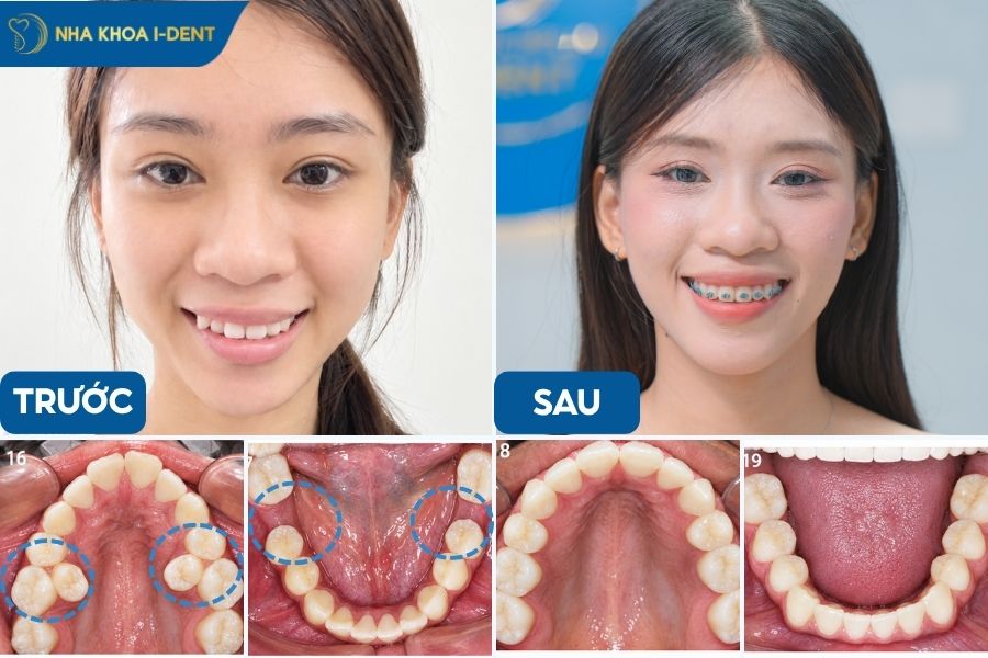 Niềng răng cần nhổ răng để tạo khoảng trống di chuyển răng