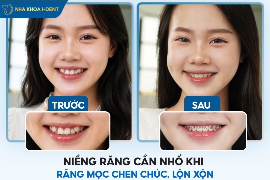 niềng răng có nhổ răng không