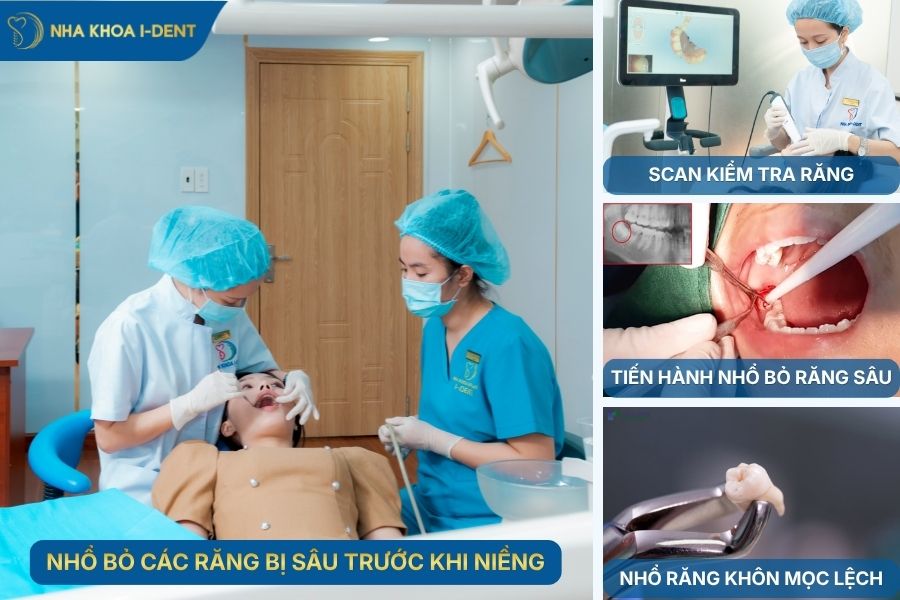 Trước khi niềng cần nhổ bỏ các răng bị sâu, hư tổn không thể phục hồi