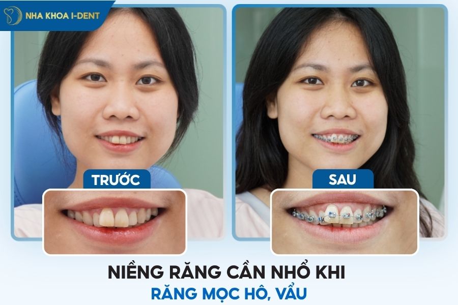 niềng răng nhổ răng nào