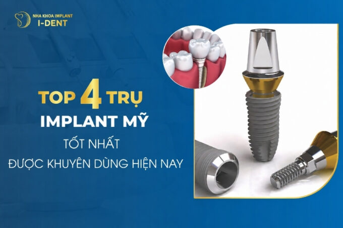 Top 4 Dòng Trụ Implant Mỹ Được Ưa Chuộng Nhất Hiện Nay