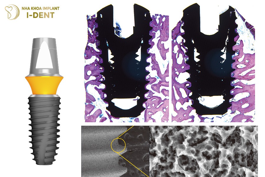 Trụ Implant Mỹ có khả năng tích hợp xương khác nhau
