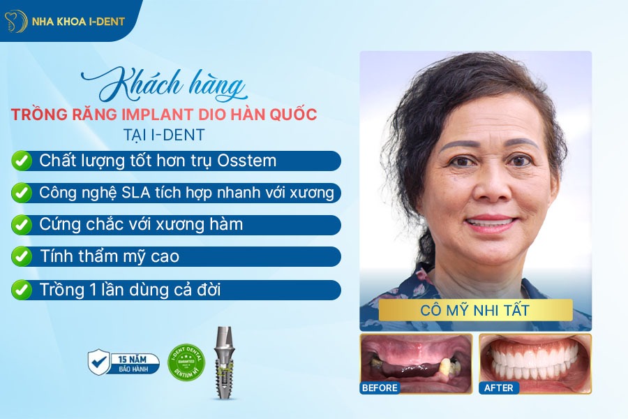 trụ implant osstem của hàn quốc
