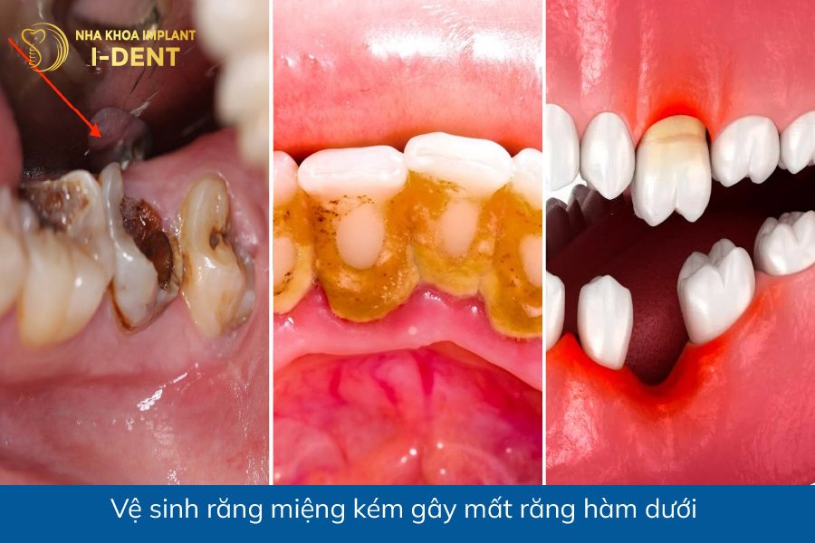 Vệ sinh răng miệng kém gây mất răng hàm dưới mất răng hàm dưới có nguy hiểm không