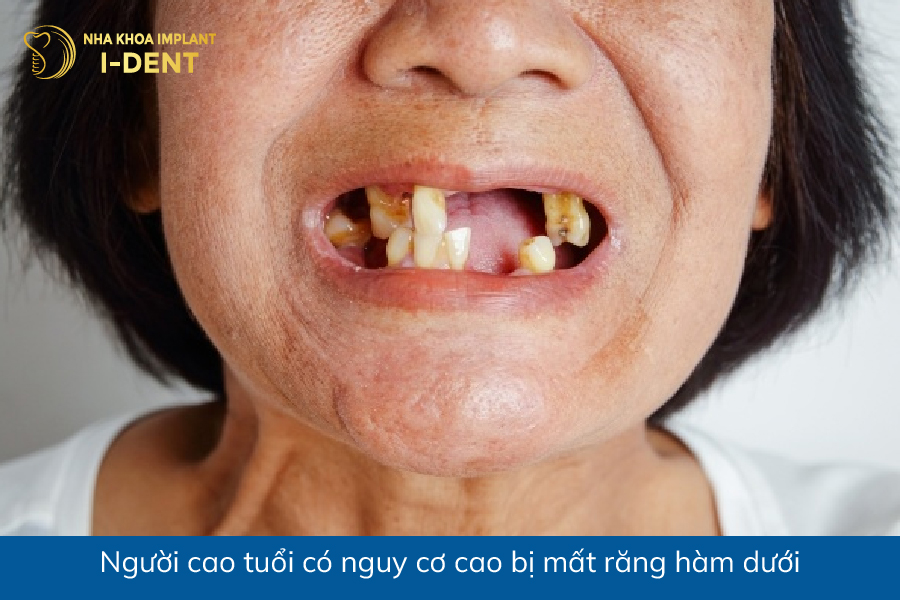 Người cao tuổi có nguy cơ cao bị mất răng hàm dưới Người cao tuổi có nguy cơ cao bị mất răng hàm dưới