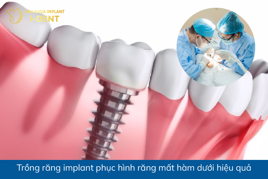 Trồng răng implant phục hình răng mất hàm dưới hiệu quả mất răng hàm ở dưới