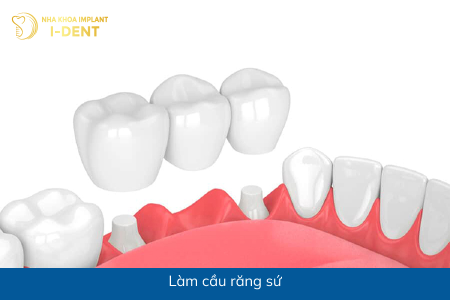 Làm cầu răng sứ mất các răng hàm dưới