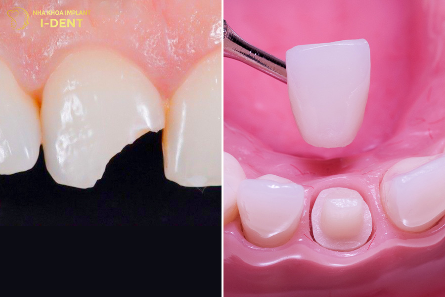 Bọc răng sứ răng bị gãy răng bị gãy chân