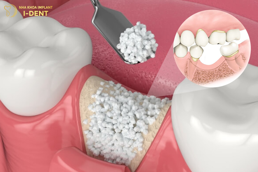 Cần ghép xương trước khi trồng răng implant nếu xương hàm không đáp ứng đủ điều kiện tiêu xương hàm có trồng răng được không