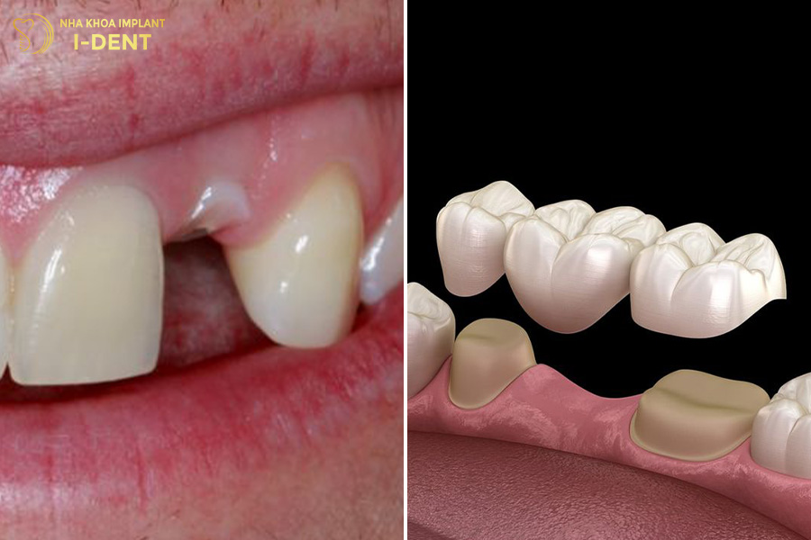 Làm cầu răng sứ răng bị gãy chân