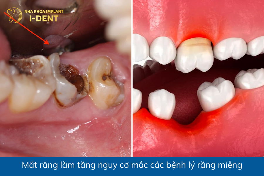 Mất răng làm tăng nguy cơ mắc các bệnh lý răng miệng mất răng thì phải làm sao