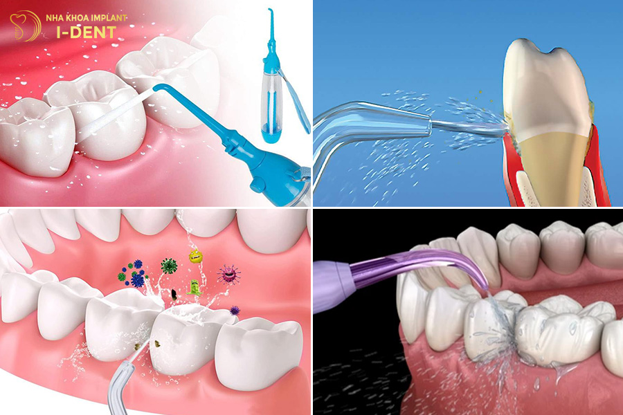Máy tăm nước làm sạch mảng bám hiệu quả có nên dùng tăm nước