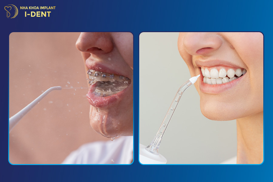 Máy tăm nước rất hữu ích cho người niềng răng, có răng giả dùng tăm nước có tốt không