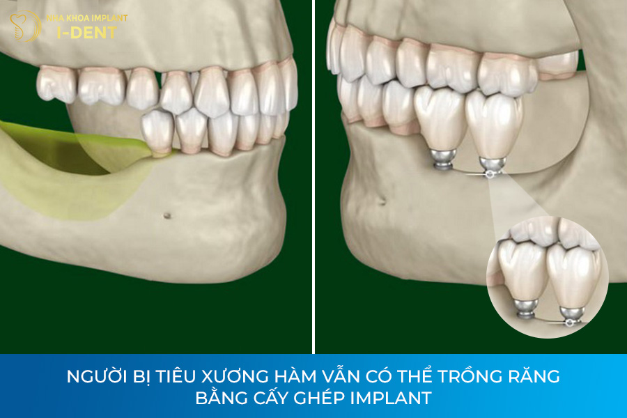 Người bị tiêu xương hàm vẫn có thể trồng răng bằng cấy ghép implant trồng răng khi bị tiêu xương hàm