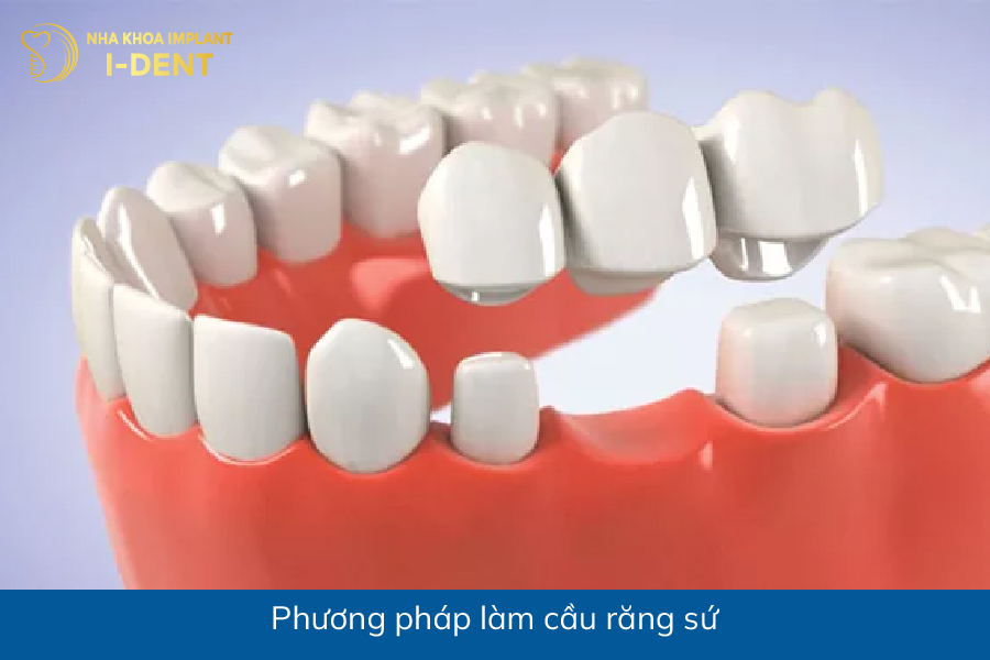 Phương pháp làm cầu răng sứ mất răng nên làm gì