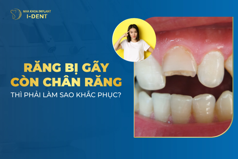 Răng bị gãy còn chân răng phải làm sao? Cách điều trị hiệu quả