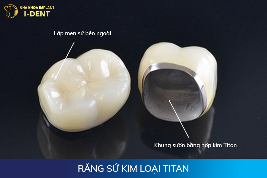 Răng sứ kim loại Titan răng sứ có mấy loại