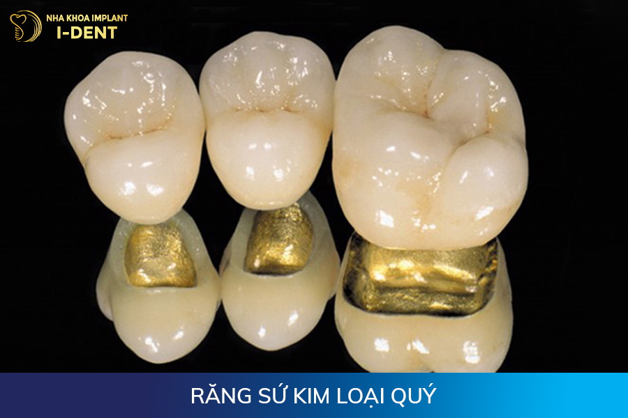Răng sứ kim loại quý có mấy loại răng sứ