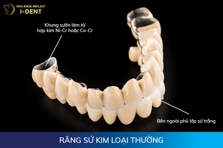 Răng sứ kim loại thường các loại răng sứ