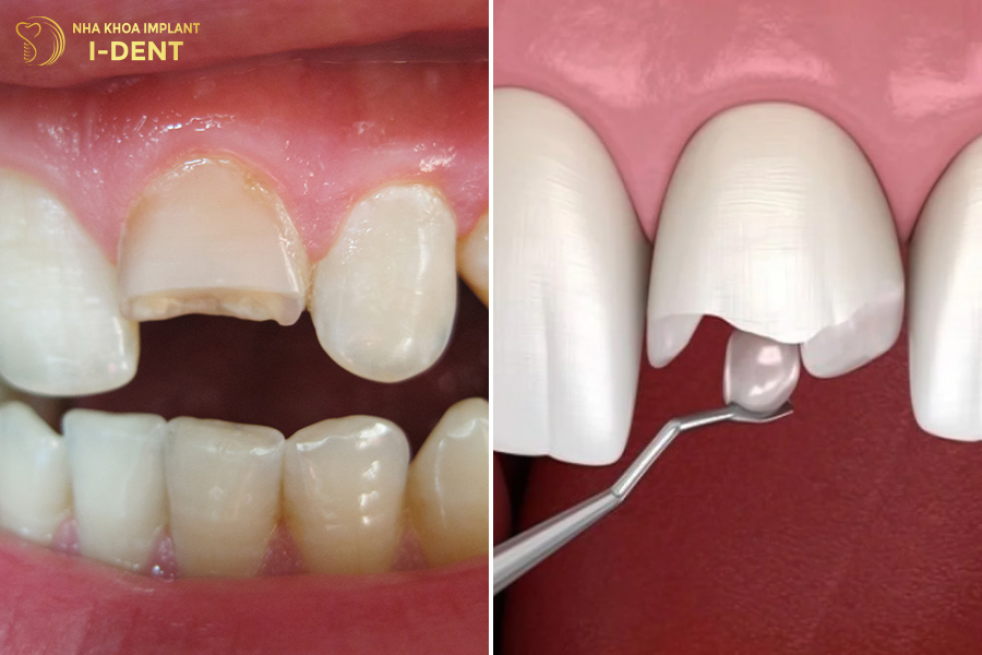Trám răng bị gãy răng bị gãy