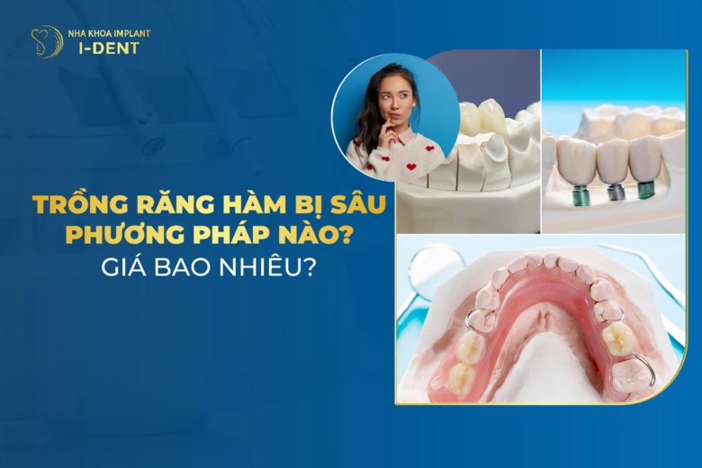 Trồng răng hàm bị sâu phương pháp nào? Giá bao nhiêu?