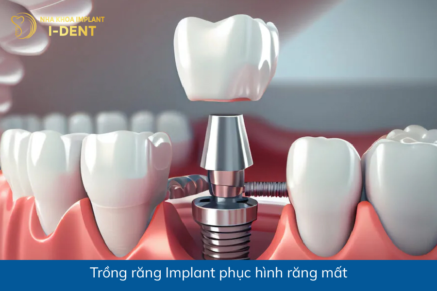 Trồng răng implant phục hình răng mất mất răng thì phải làm sao