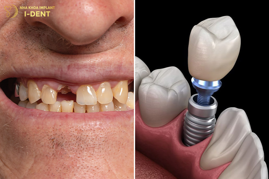 Trồng răng implant răng bị gãy đôi