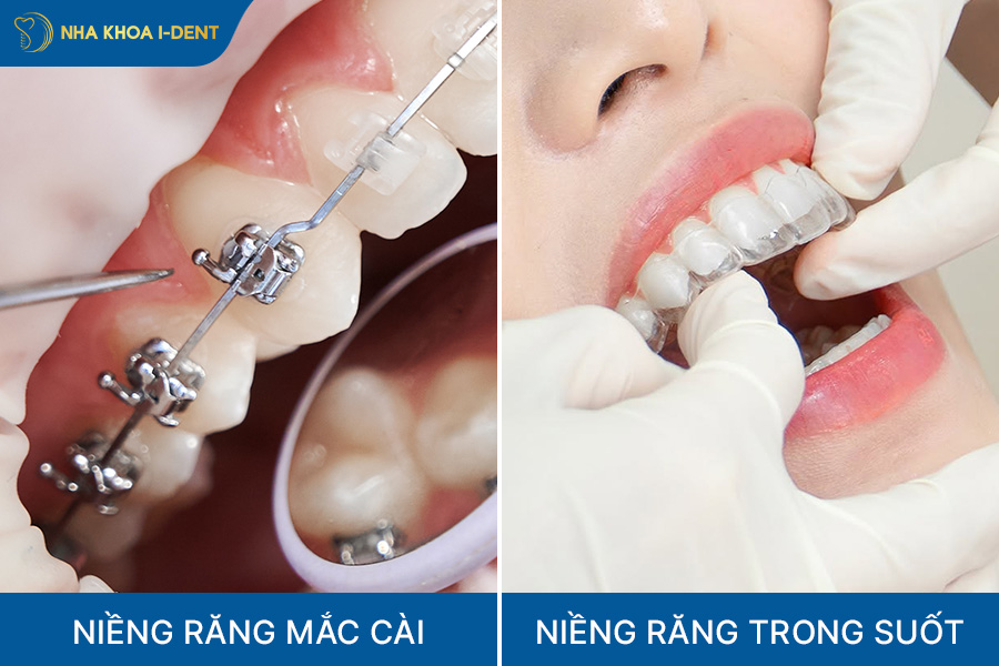 quy trình niềng răng