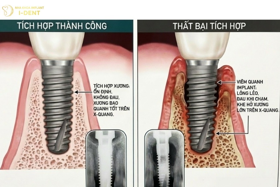cấy răng implant có ảnh hưởng gì không