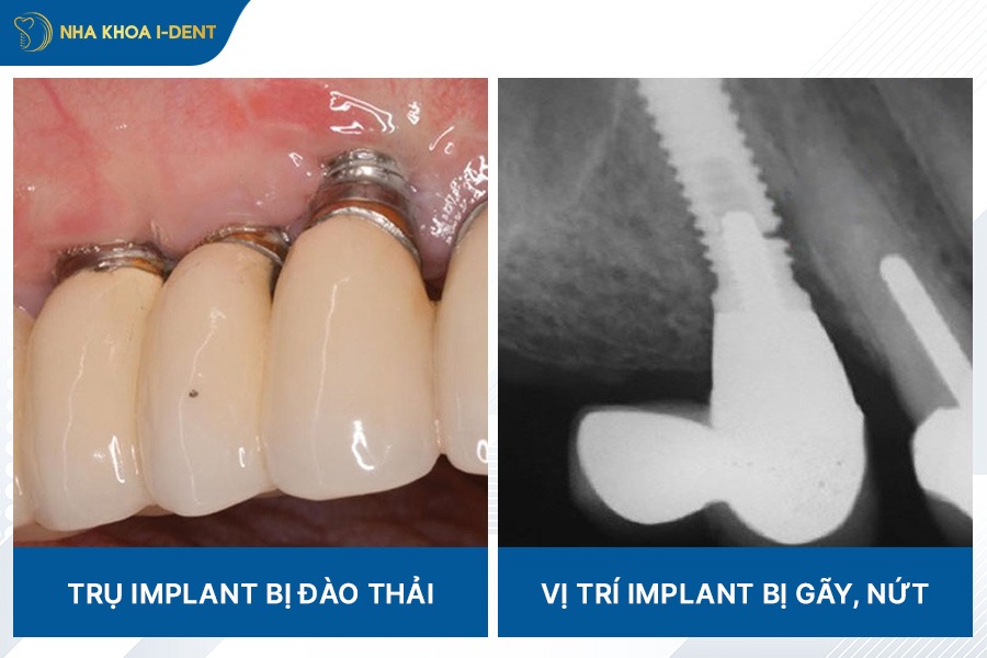 có nên trồng răng implant