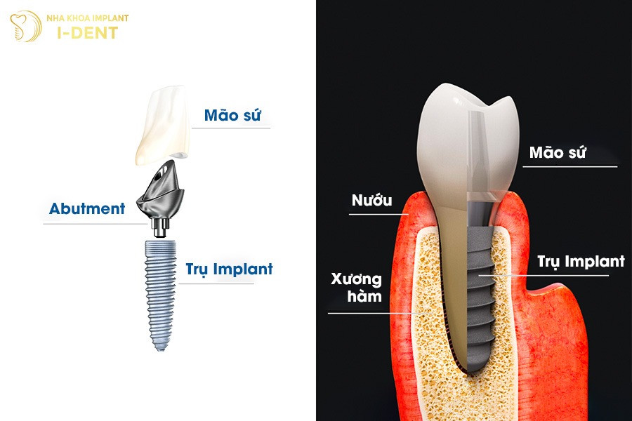 trồng răng implant là gì