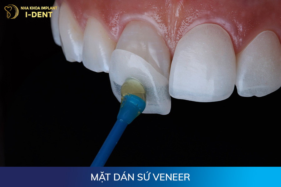 Mặt dán sứ Veneer các loại răng sứ trên thị trường