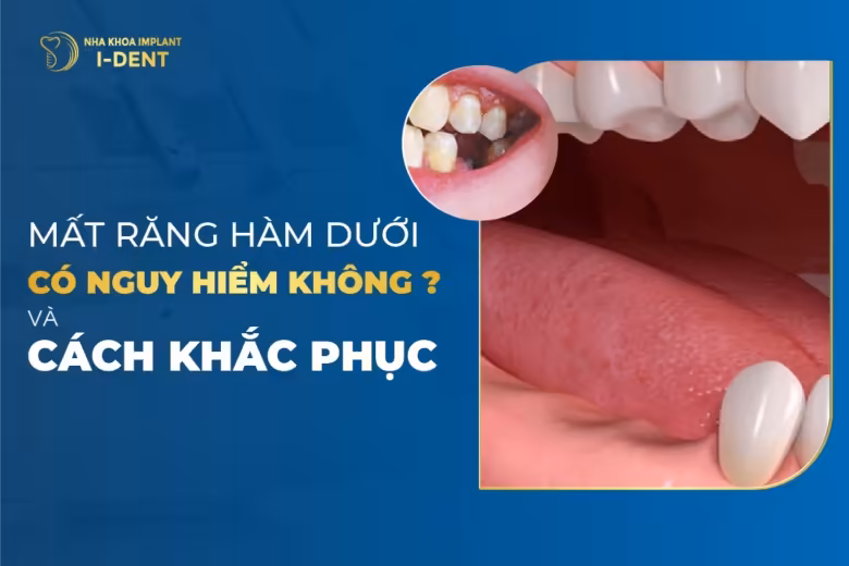 Mất răng hàm dưới có nguy hiểm không? Cách khắc phục