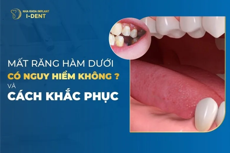 Mất răng hàm dưới có nguy hiểm không? Cách khắc phục