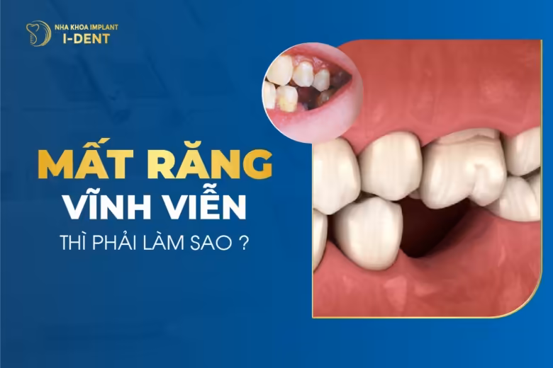 mất răng thì phải làm sao