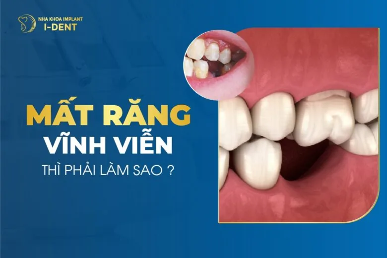 mất răng thì phải làm sao