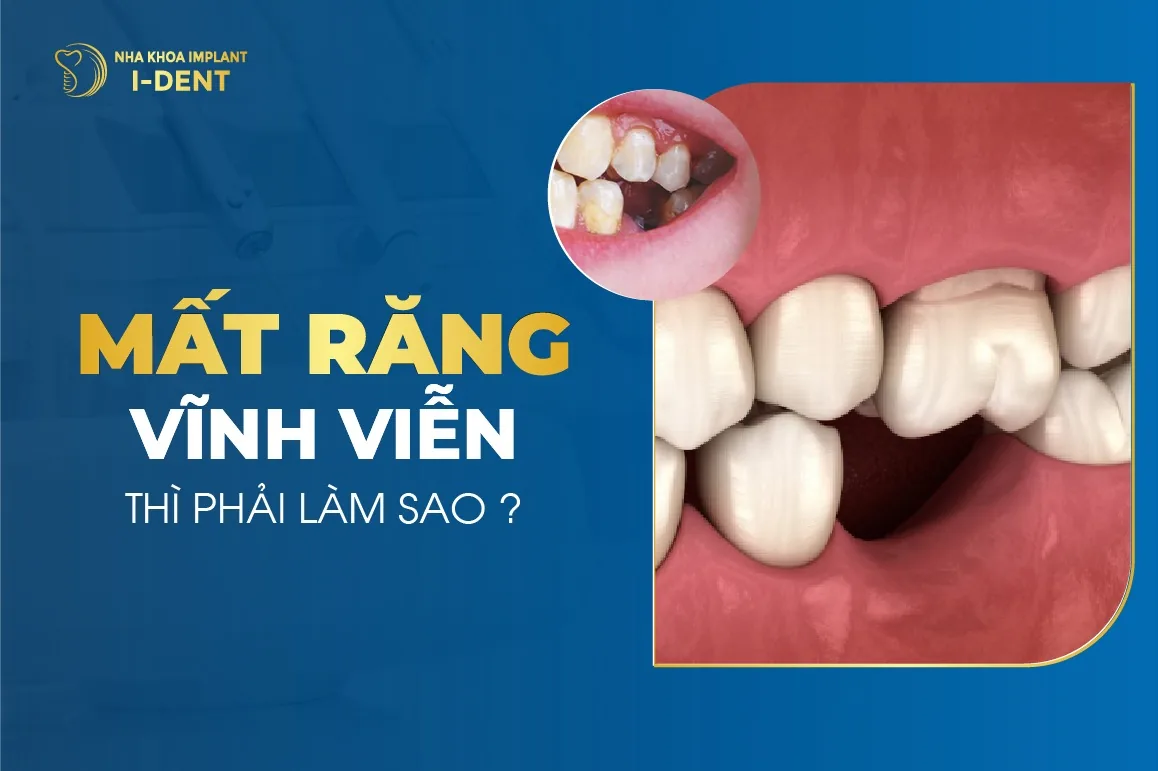 mất răng thì phải làm sao