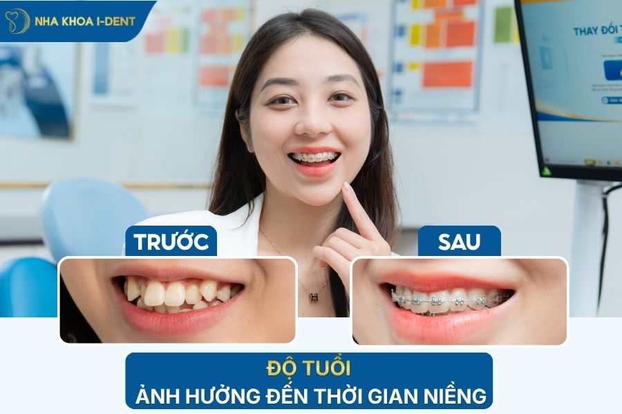 niềng răng bao lâu