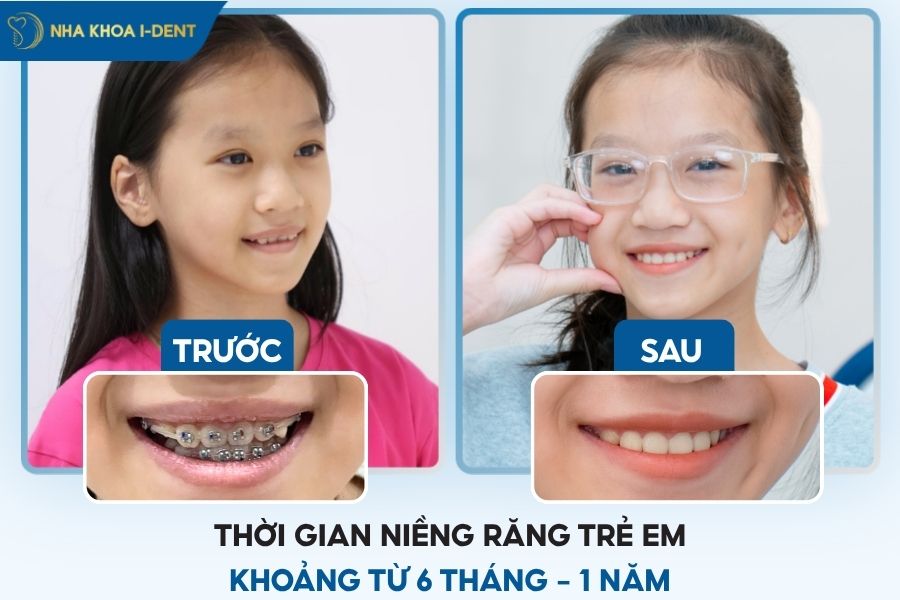 niềng răng mất bao lâu