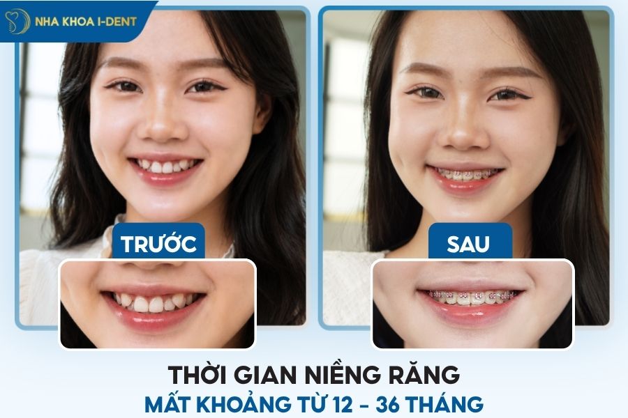 niềng răng trong bao lâu