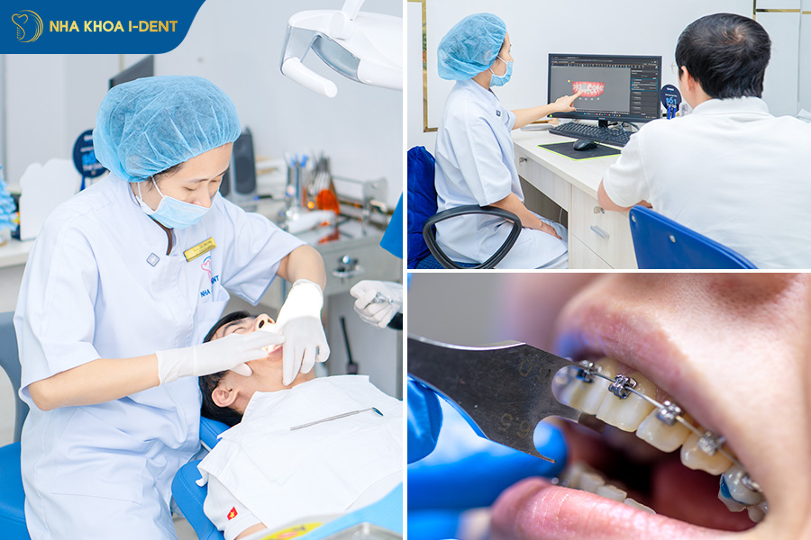 các bước niềng răng