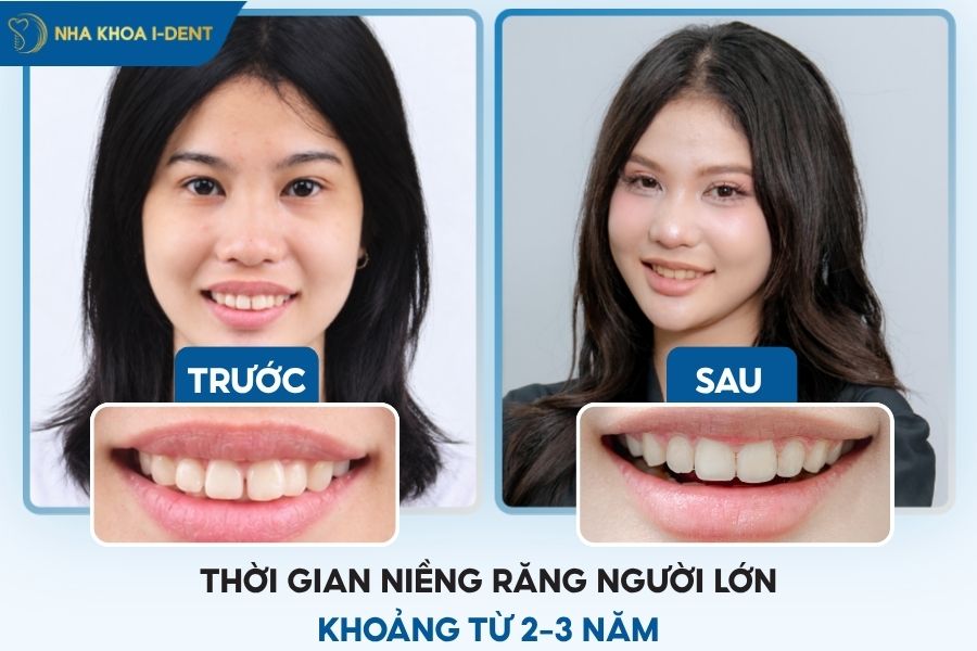 quá trình niềng răng mất bao lâu