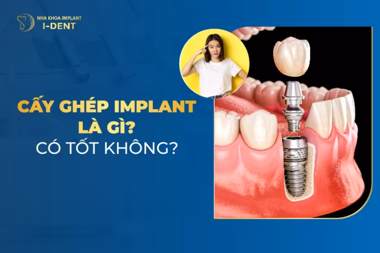 cấy ghép implant