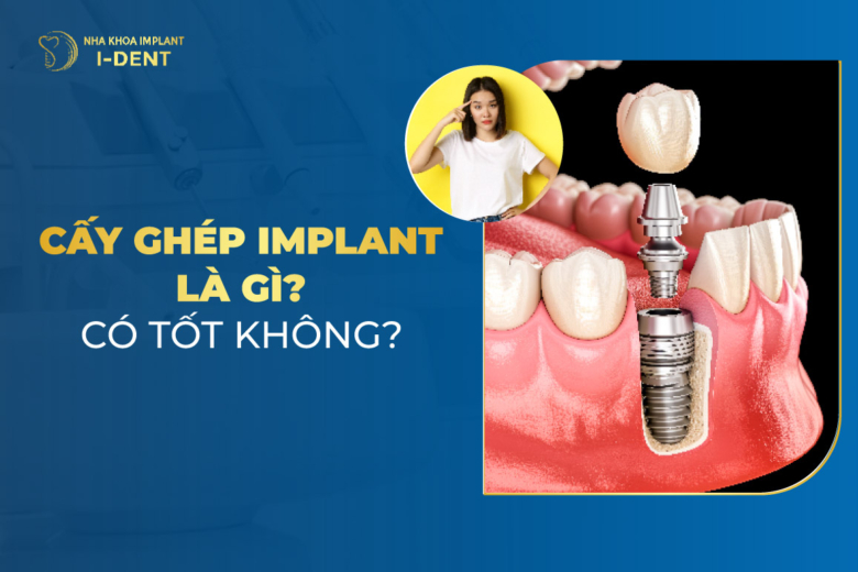 Kỹ thuật cấy ghép implant là gì? Lưu ý trước khi cấy